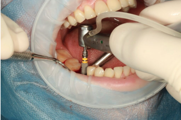 Implants Dentist in North County San Diego (Carlsbad, Vista, Oceanside, Encinitas, San Marcos, Escondido)