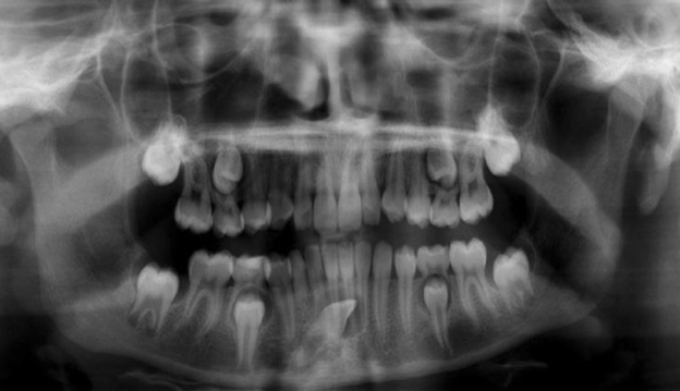 Implants Dentist in North County San Diego (Carlsbad, Vista, Oceanside, Encinitas, San Marcos, Escondido)